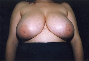 Breast Reduction 2a